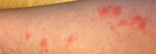 Photo of bed bug bites in Wisconsin - Batzner Pest Control