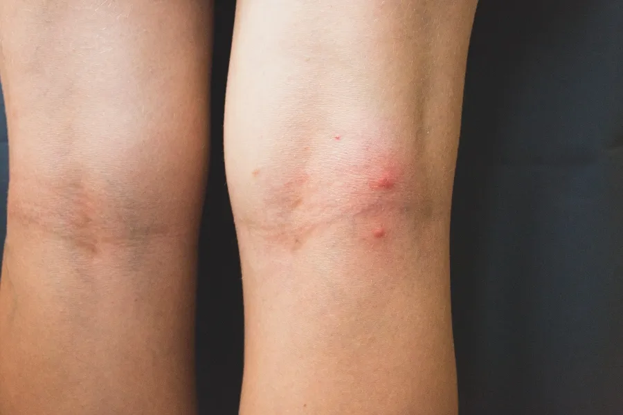 Close-up of small, red, and itchy bed bug bites on the back of a person's legs.