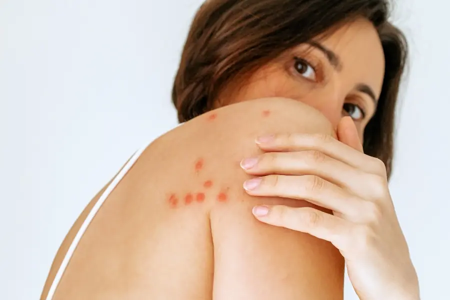 Close-up of a cluster of red, swollen bed bug bites on a woman's shoulder.